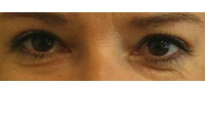 Manhattan BLEPHAROPLASTY after 2